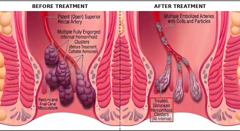 Two-panel cross-section of the anal canal. Before treatment: an open superior rectal artery feeding several engorged internal hemorrhoid clusters. After treatment: the feeding branches embolized with coils and particles, and the hemorrhoid clusters shrunken