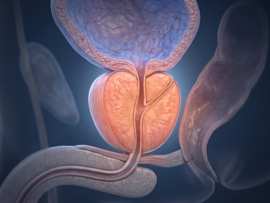 Anatomical illustration of an enlarged prostate pressing on the urethra beneath the bladder