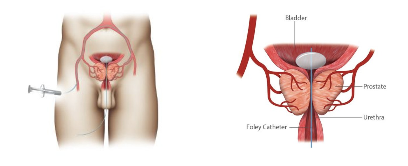 Diagram of a catheter passed from the top of the thigh into the arteries supplying the prostate, with the bladder, prostate and urethra labelled