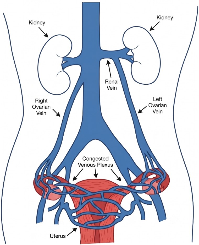 Diagram of the ovarian veins draining into the renal vein and vena cava, with a congested venous plexus around the uterus