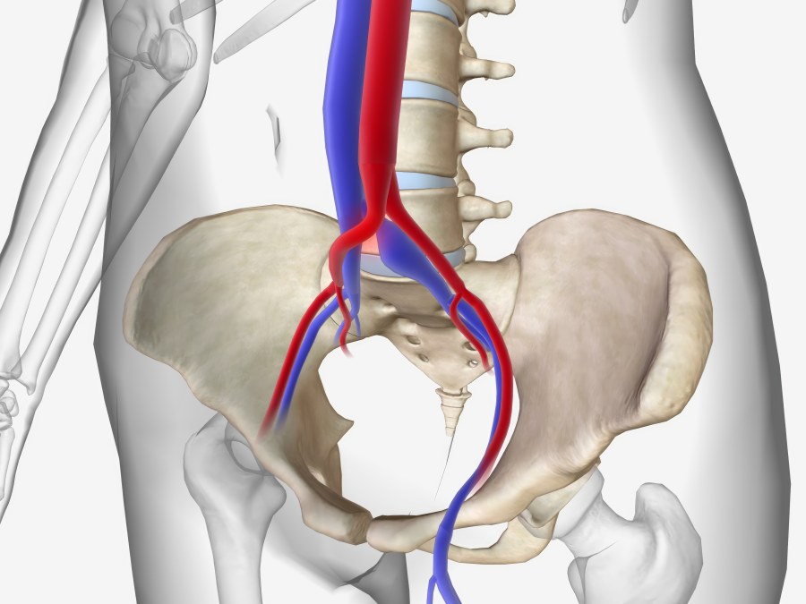 May-Thurner Syndrome