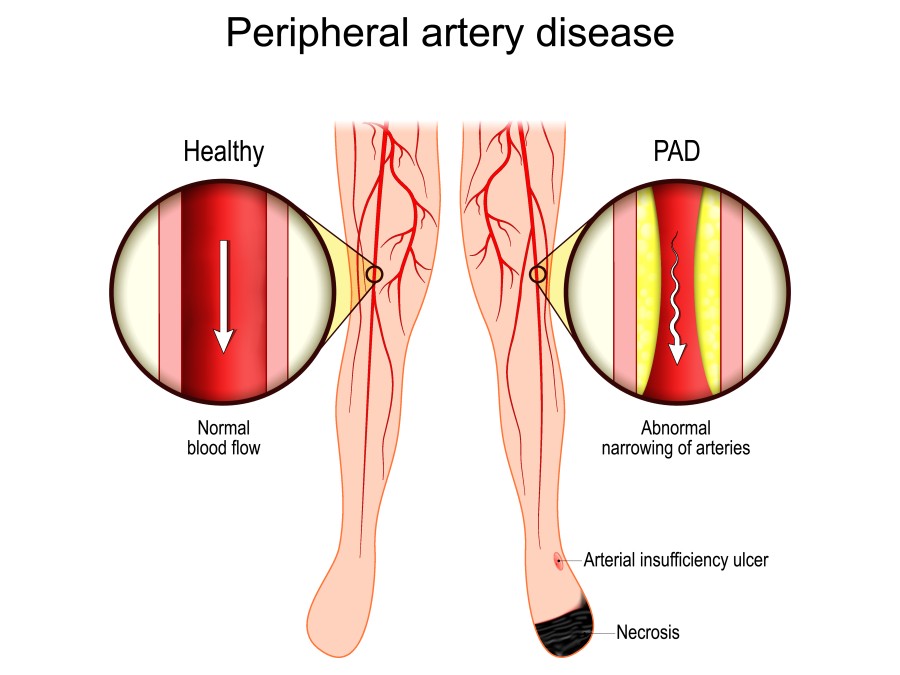 Diagram comparing healthy arterial blood flow with peripheral artery disease