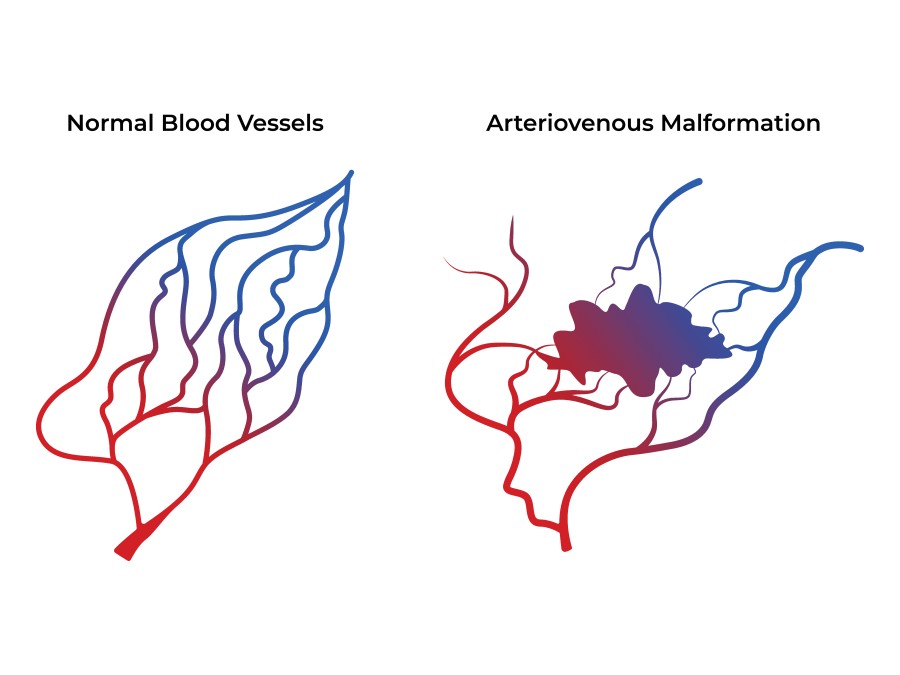 Diagram comparing normal blood vessels with an arteriovenous malformation