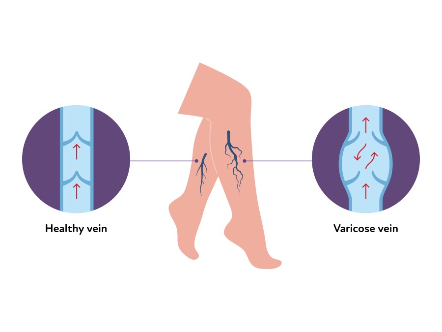 Diagram comparing a healthy vein with a varicose vein