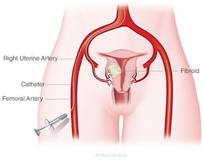 Diagram showing a catheter passed from the femoral artery to the uterine arteries supplying a fibroid