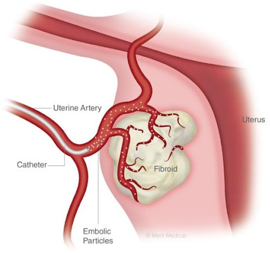 Diagram showing embolic particles being released into the uterine artery to block blood flow to a fibroid