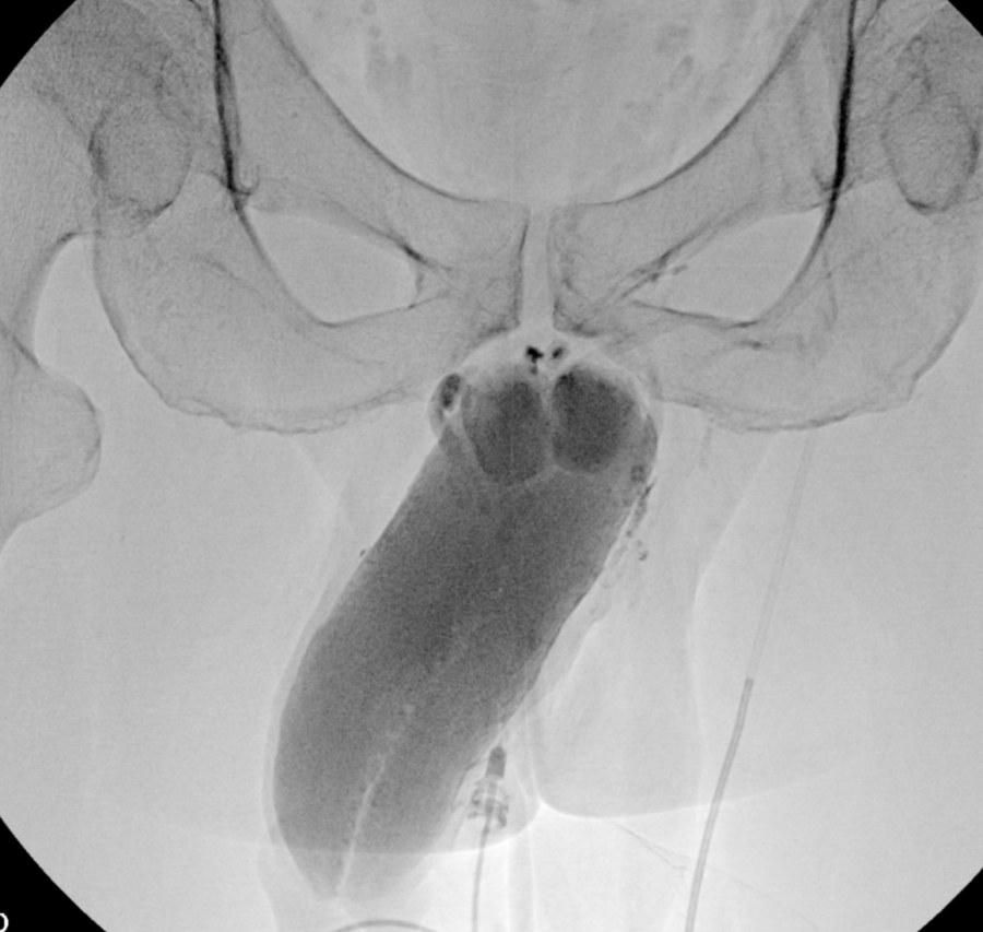 Cavernosogram showing contrast filling the corpus cavernosum during a venous leak study
