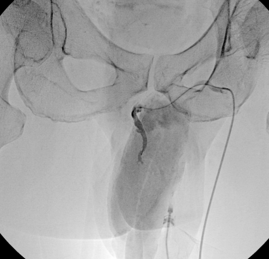 Follow-up image after embolization showing the leaking vein sealed